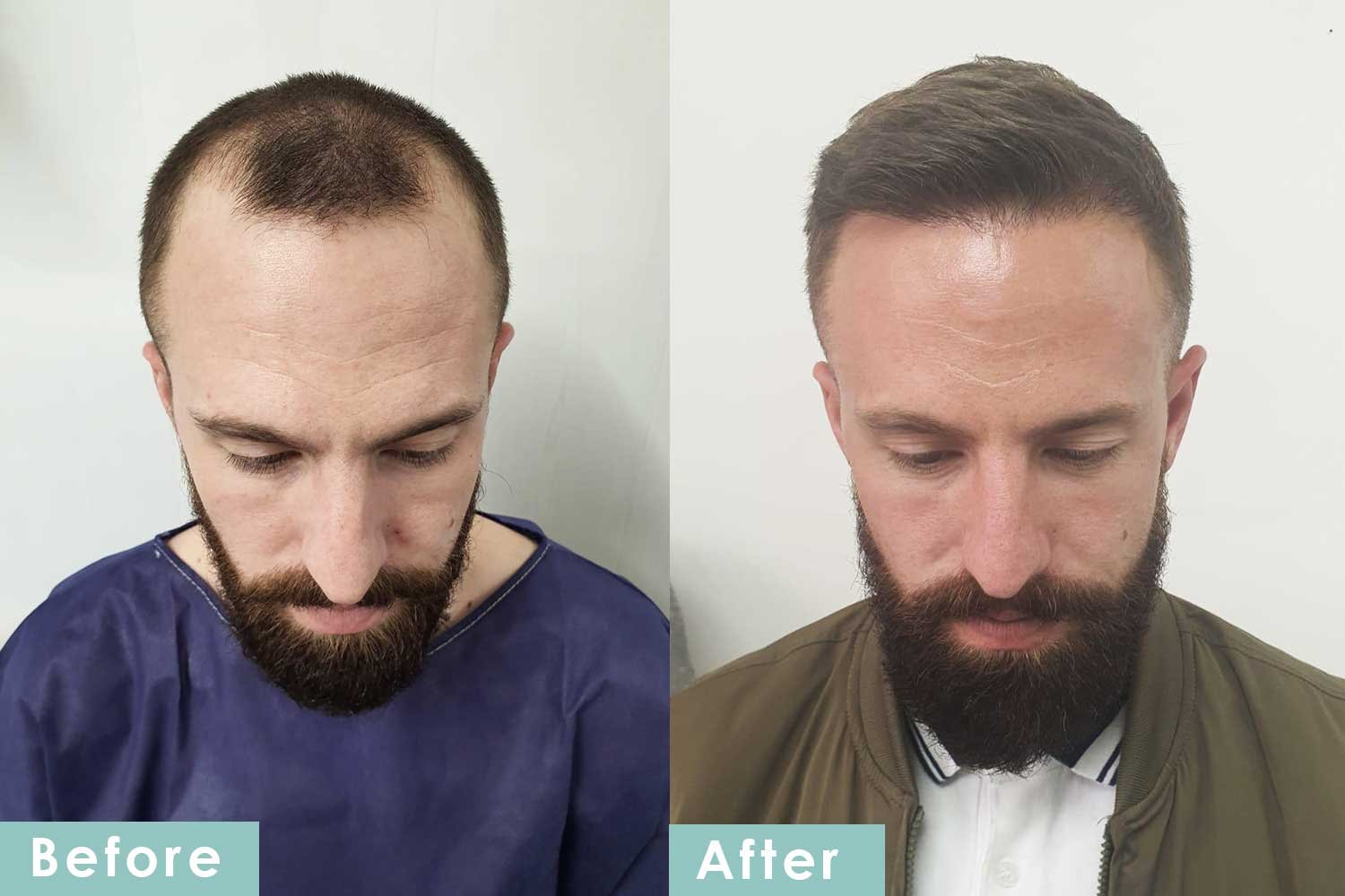 Before and After
